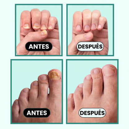 OrthoNails: Reparador Antifúngico Laser by Orelvie
